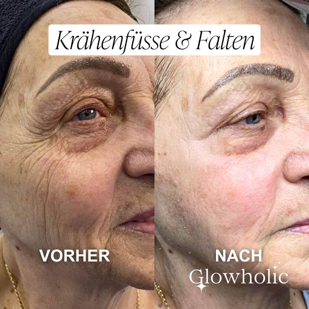 Schweizer Anti-Falten Starter Set - Glowholic Micro-Needling-Infusion